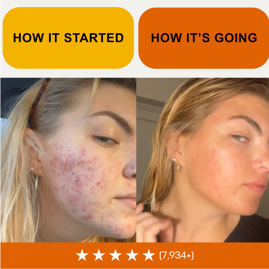 The Complete Acne Stopper Starter Pack