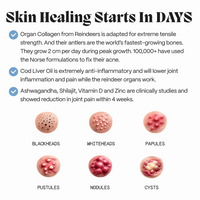 Complete Gut Repair & Hormonal Balance System for Female Acne